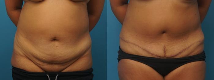 Before & After Abdominoplasty/Tummy Tuck Case 403 Front View in North Shore, IL