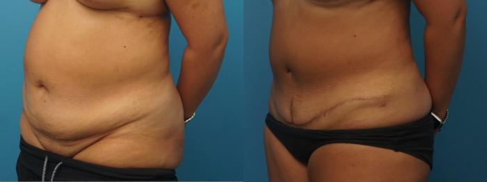 Before & After Abdominoplasty/Tummy Tuck Case 403 Left Oblique View in North Shore, IL