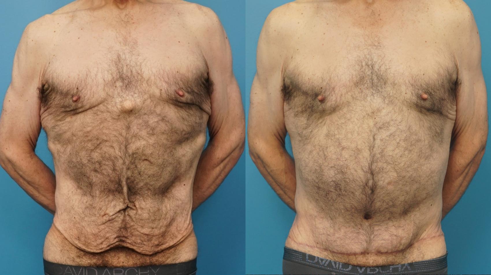 Before & After Abdominoplasty/Tummy Tuck Case 405 Front View in North Shore, IL