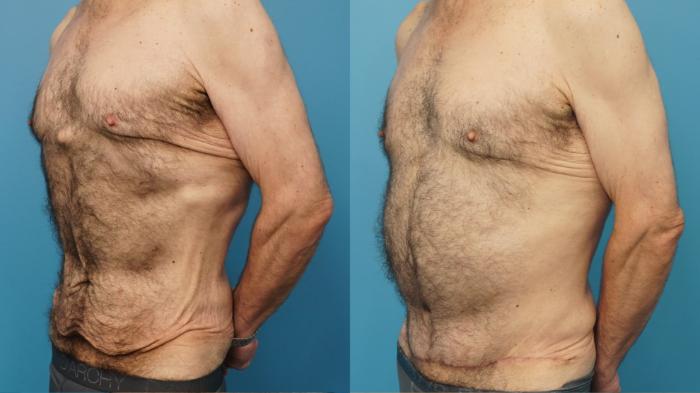 Before & After Abdominoplasty/Tummy Tuck Case 405 Left Oblique View in North Shore, IL