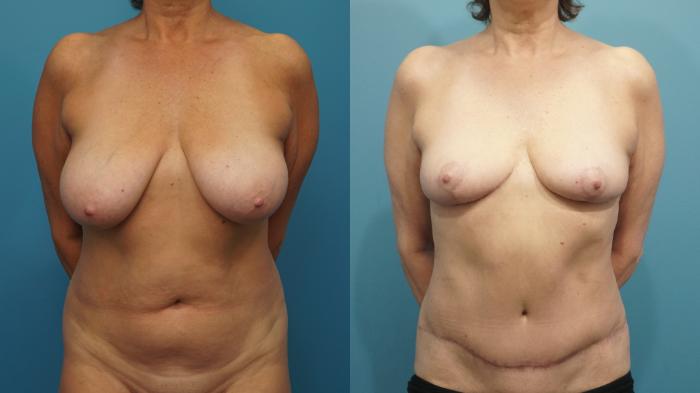 Before & After Liposuction Case 440 Front View in North Shore, IL