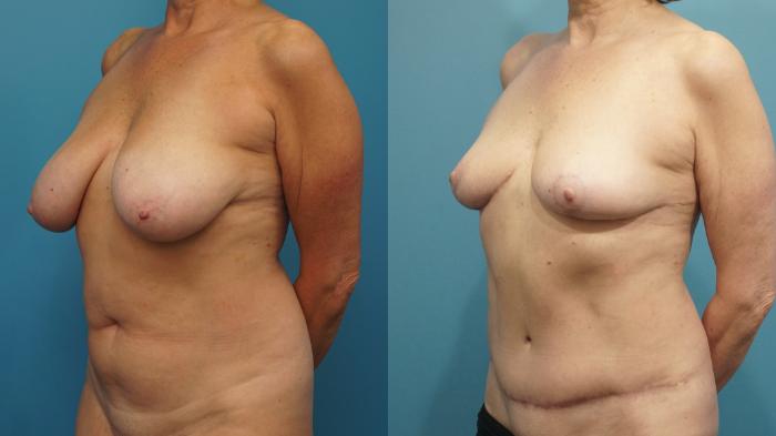 Before & After Breast Lift (Mastopexy) Case 440 Left Oblique View in North Shore, IL