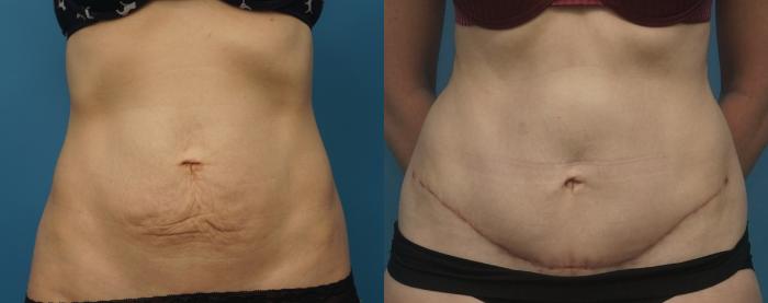 Before & After Abdominoplasty/Tummy Tuck Case 441 Front View in North Shore, IL