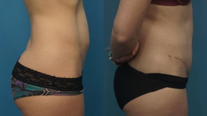 Before & After Abdominoplasty/Tummy Tuck Case 441 Right Side View in North Shore, IL