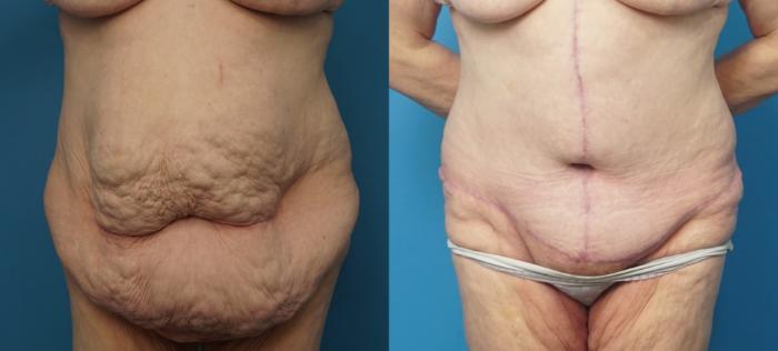 Before & After Abdominoplasty/Tummy Tuck Case 442 Front View in North Shore, IL