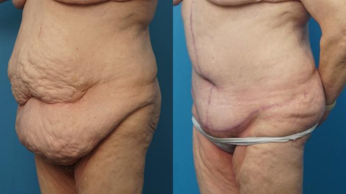 Before & After Abdominoplasty/Tummy Tuck Case 442 Left Oblique View in North Shore, IL