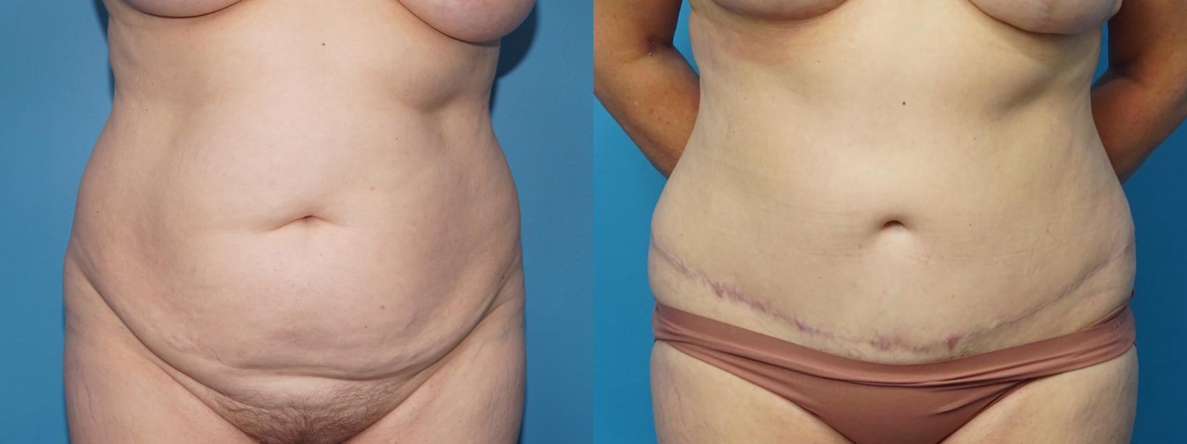 Before & After Abdominoplasty/Tummy Tuck Case 445 Front View in North Shore, IL