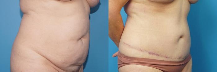 Before & After Abdominoplasty/Tummy Tuck Case 445 Right Oblique View in North Shore, IL