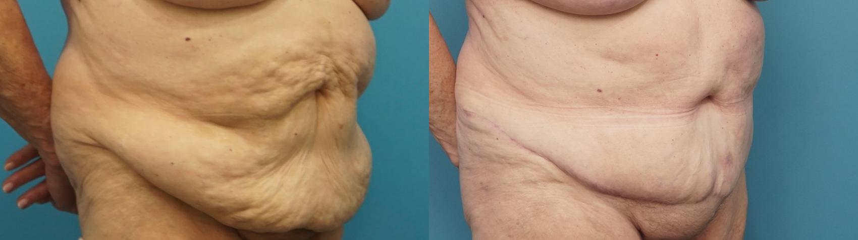 Before & After Abdominoplasty/Tummy Tuck Case 449 Right Oblique View in North Shore, IL