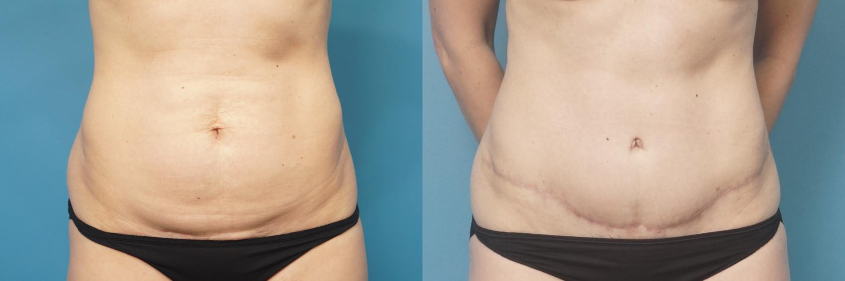 Before & After Abdominoplasty/Tummy Tuck Case 454 Front View in North Shore, IL