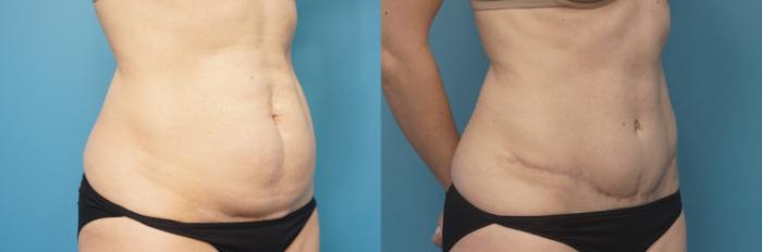 Before & After Abdominoplasty/Tummy Tuck Case 454 Right Oblique View in North Shore, IL