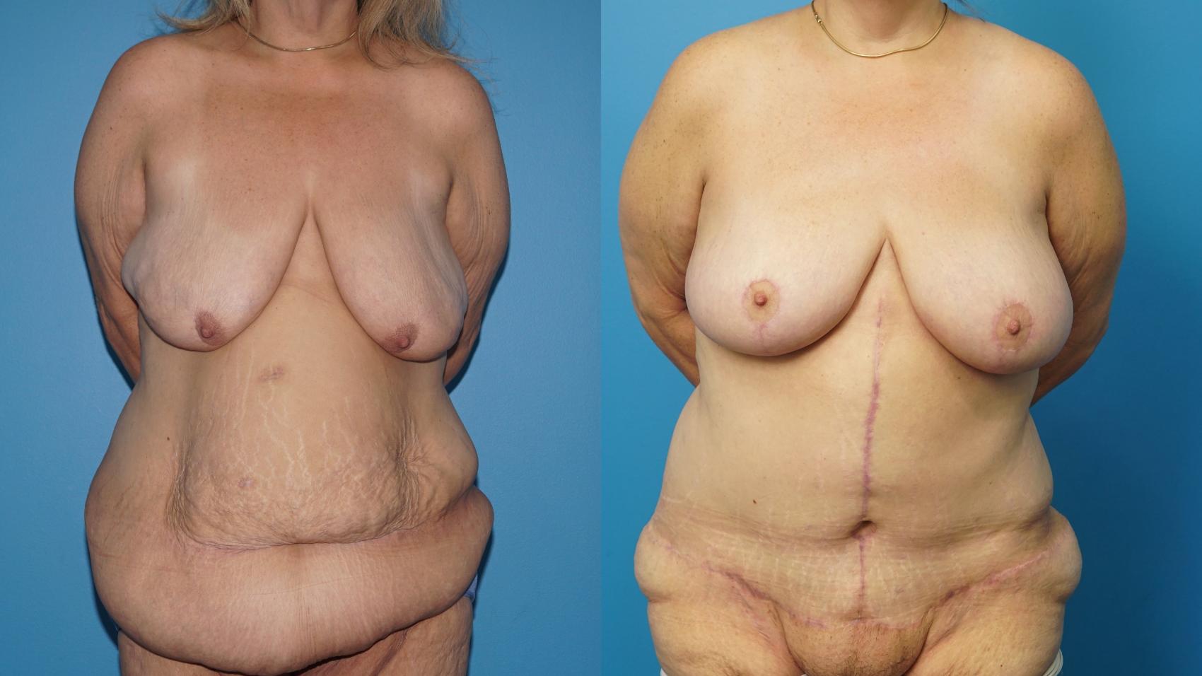 Before & After Abdominoplasty/Tummy Tuck Case 456 Front View in North Shore, IL