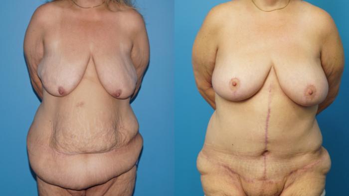 Before & After Abdominoplasty/Tummy Tuck Case 457 Front View in North Shore, IL