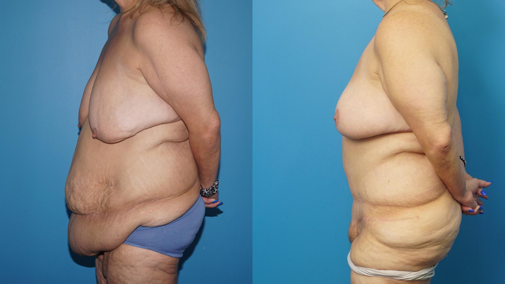 Before & After Abdominoplasty/Tummy Tuck Case 457 Left Side View in North Shore, IL