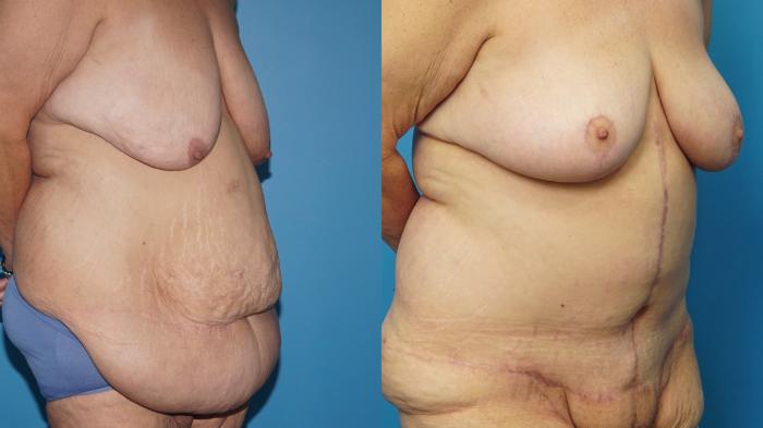 Before & After Abdominoplasty/Tummy Tuck Case 457 Right Oblique View in North Shore, IL