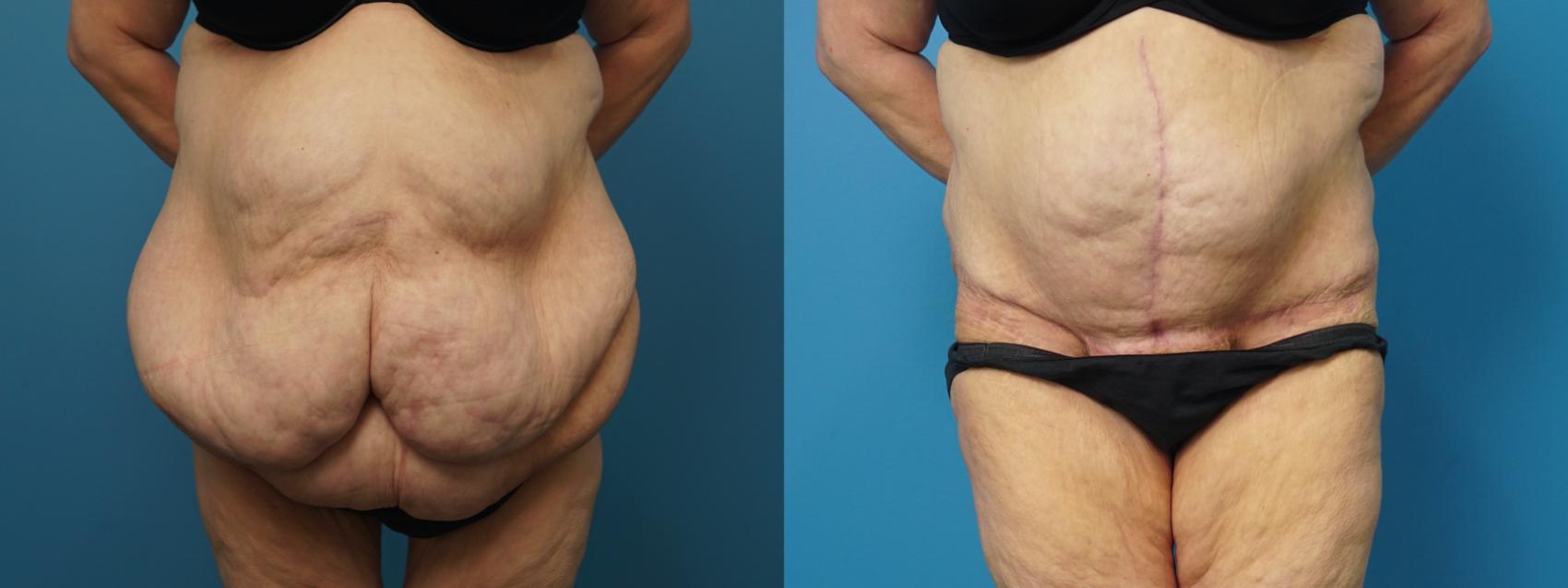 Before & After Abdominoplasty/Tummy Tuck Case 460 Front View in North Shore, IL