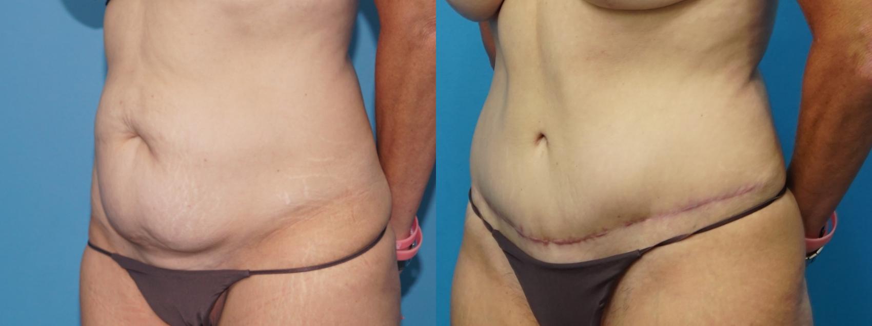 Before & After Abdominoplasty/Tummy Tuck Case 463 Left Oblique View in North Shore, IL