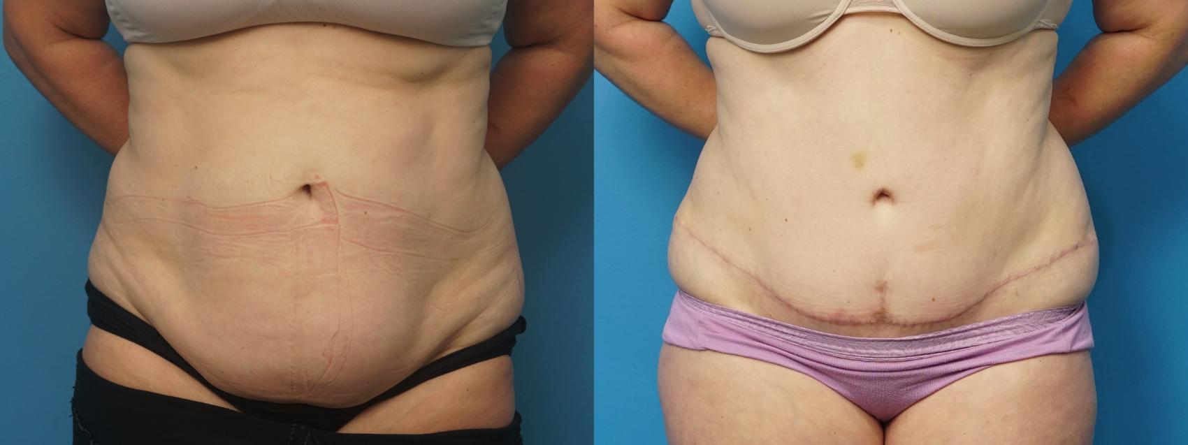 Before & After Liposuction Case 464 Front View in North Shore, IL