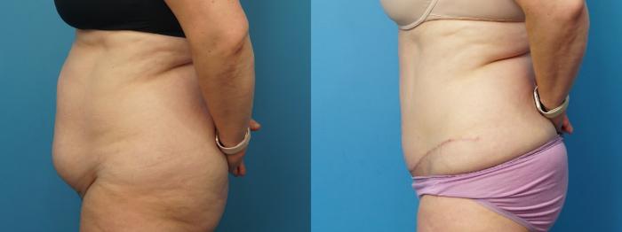 Before & After Abdominoplasty/Tummy Tuck Case 464 Left Side View in North Shore, IL