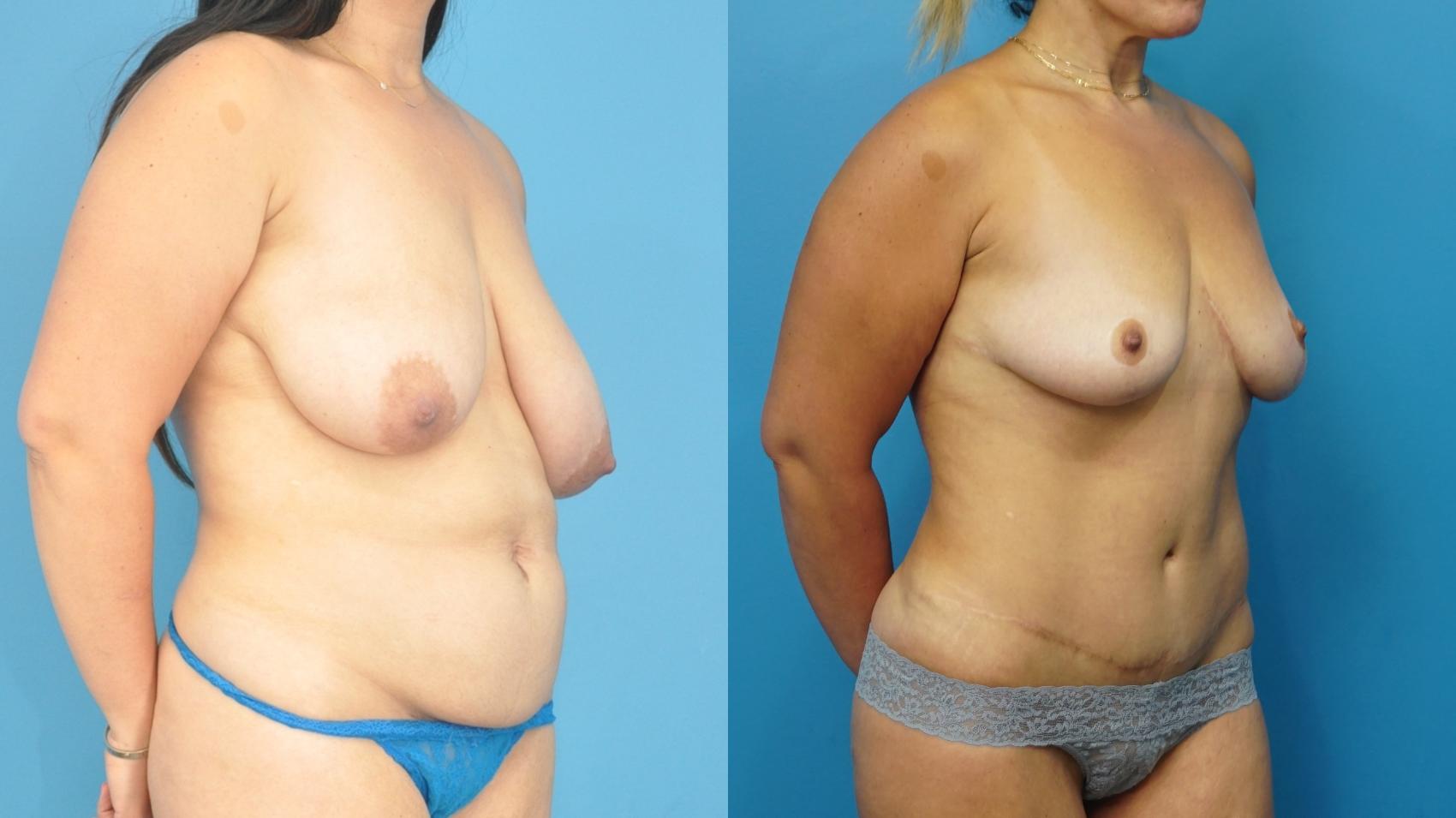 Before & After Mommy Makeover Case 466 Right Oblique View in North Shore, IL