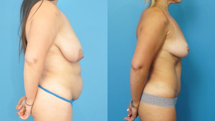 Before & After Abdominoplasty/Tummy Tuck Case 466 Right Side View in North Shore, IL