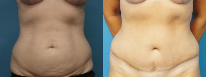 Before & After Abdominoplasty/Tummy Tuck Case 468 Front View in North Shore, IL