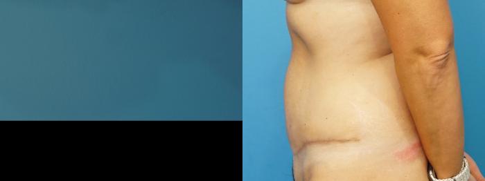 Before & After Abdominoplasty/Tummy Tuck Case 468 Left Side View in North Shore, IL