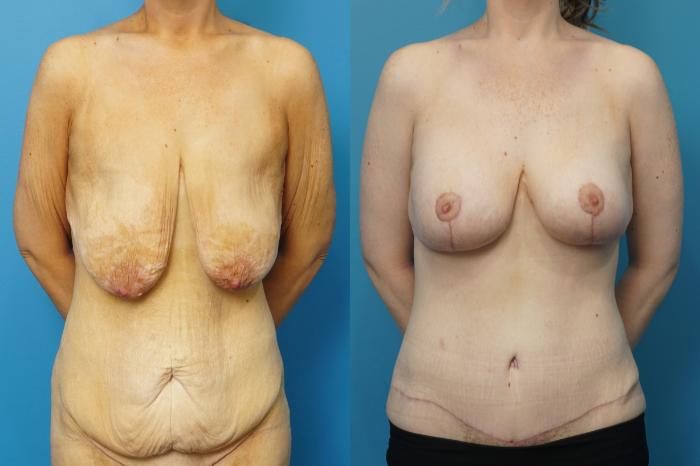 Before & After Abdominoplasty/Tummy Tuck Case 478 Front View in North Shore, IL