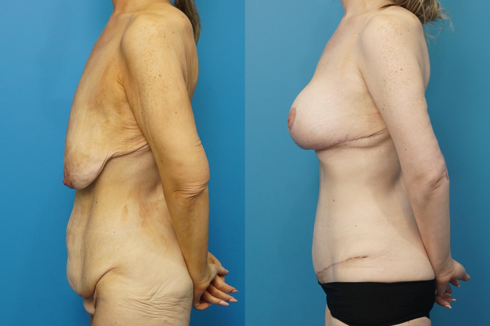 Before & After Abdominoplasty/Tummy Tuck Case 478 Left Side View in North Shore, IL