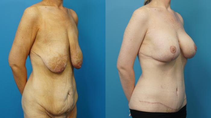 Before & After Abdominoplasty/Tummy Tuck Case 478 Right Oblique View in North Shore, IL