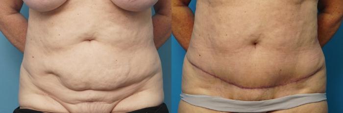 Before & After Abdominoplasty/Tummy Tuck Case 480 Front View in North Shore, IL