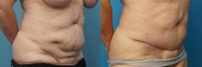 Before & After Abdominoplasty/Tummy Tuck Case 480 Right Oblique View in North Shore, IL