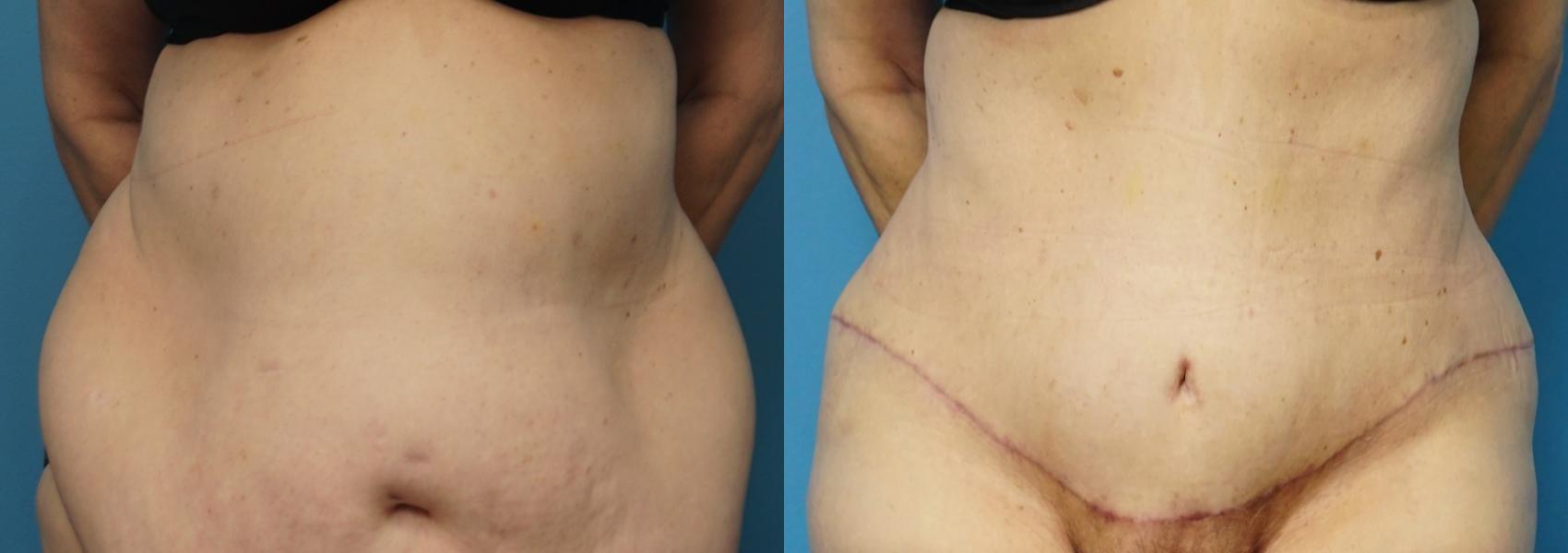 Before & After Abdominoplasty/Tummy Tuck Case 481 Front View in North Shore, IL