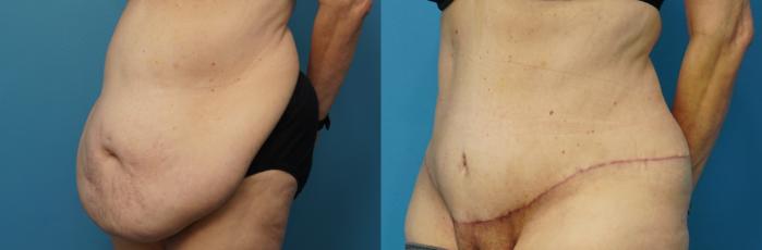 Before & After Abdominoplasty/Tummy Tuck Case 481 Left Oblique View in North Shore, IL