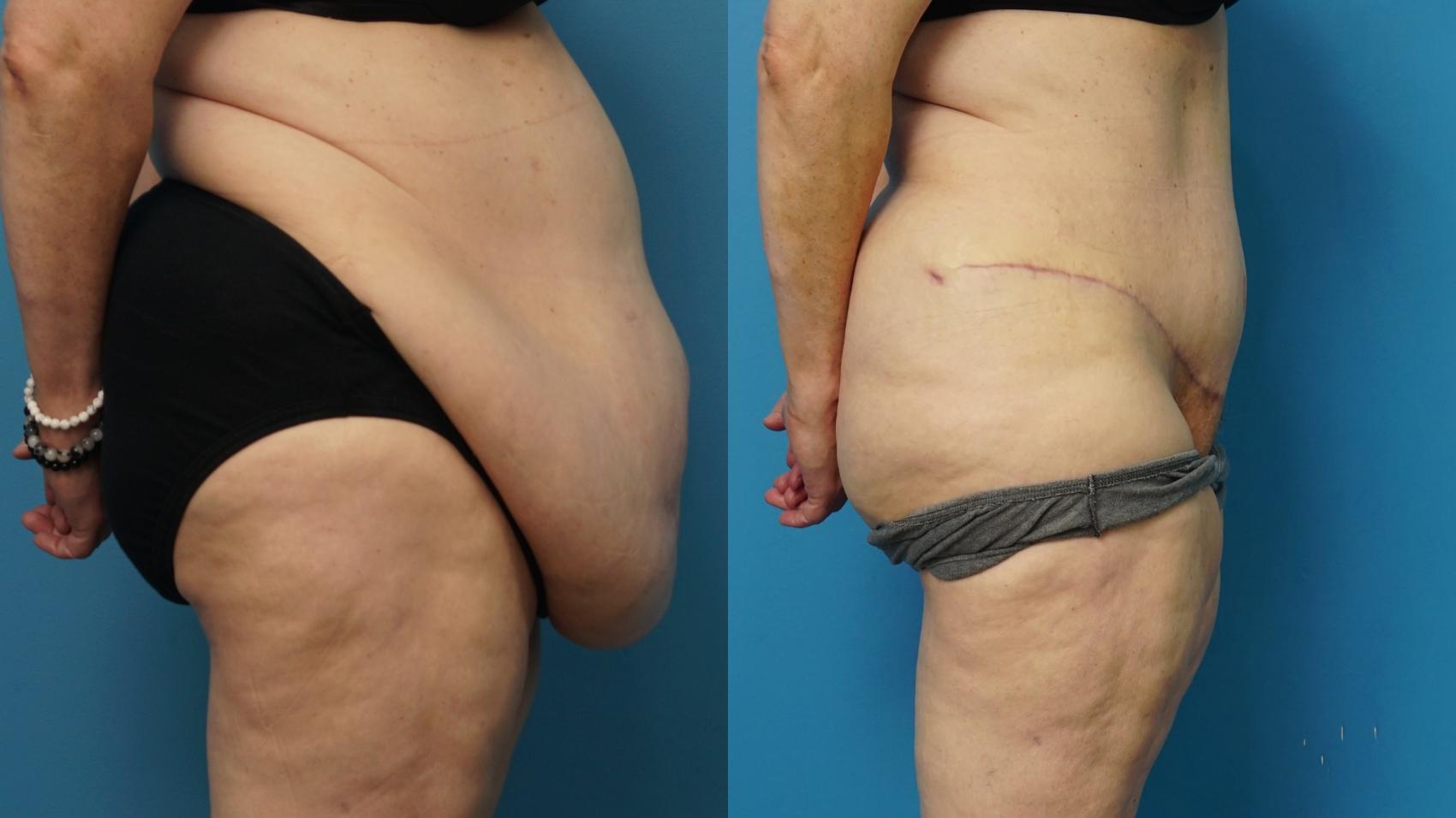 Before & After Abdominoplasty/Tummy Tuck Case 481 Right Side View in North Shore, IL