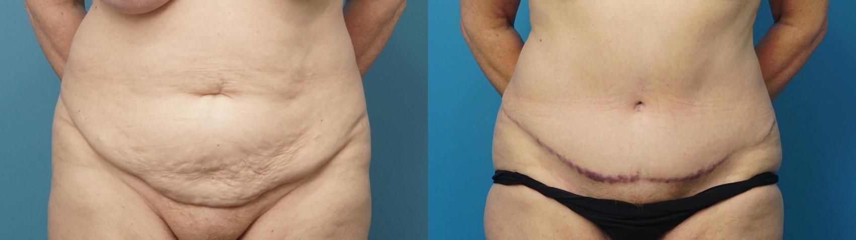 Before & After Abdominoplasty/Tummy Tuck Case 483 Front View in North Shore, IL