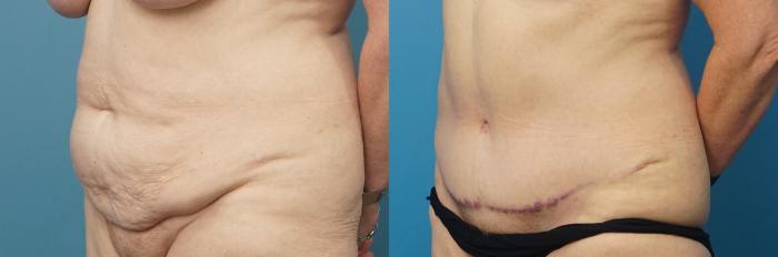 Before & After Abdominoplasty/Tummy Tuck Case 483 Left Oblique View in North Shore, IL