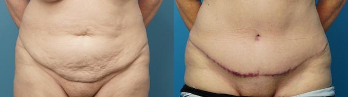 Before & After Liposuction Case 486 Front View in North Shore, IL