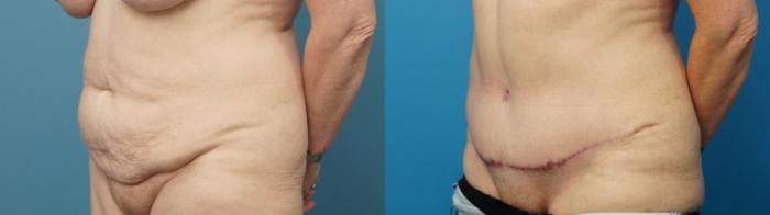 Before & After Liposuction Case 486 Left Oblique View in North Shore, IL