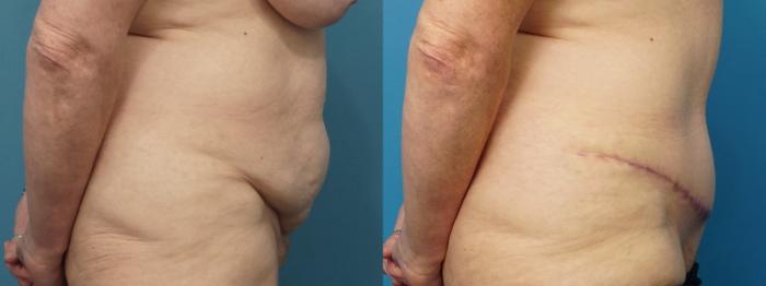 Before & After Liposuction Case 486 Right Side View in North Shore, IL