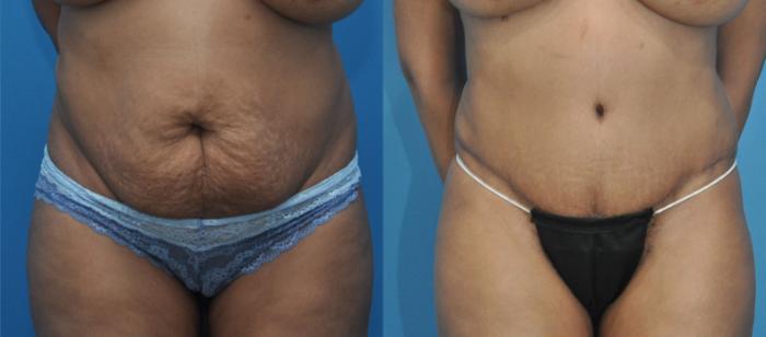 Before & After Abdominoplasty/Tummy Tuck Case 6 View #1 View in Northbrook, IL