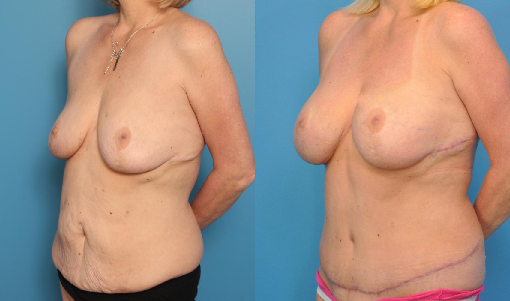 Before & After Abdominoplasty/Tummy Tuck Case 61 View #1 View in North Shore, IL