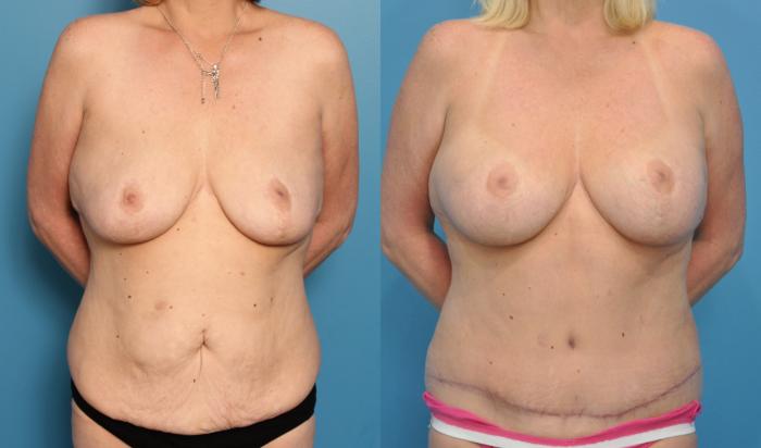Before & After Abdominoplasty/Tummy Tuck Case 61 View #2 View in North Shore, IL