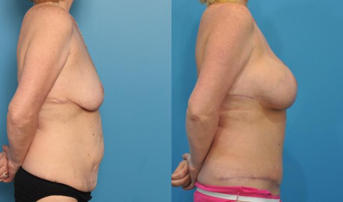 Before & After Abdominoplasty/Tummy Tuck Case 61 View #3 View in North Shore, IL