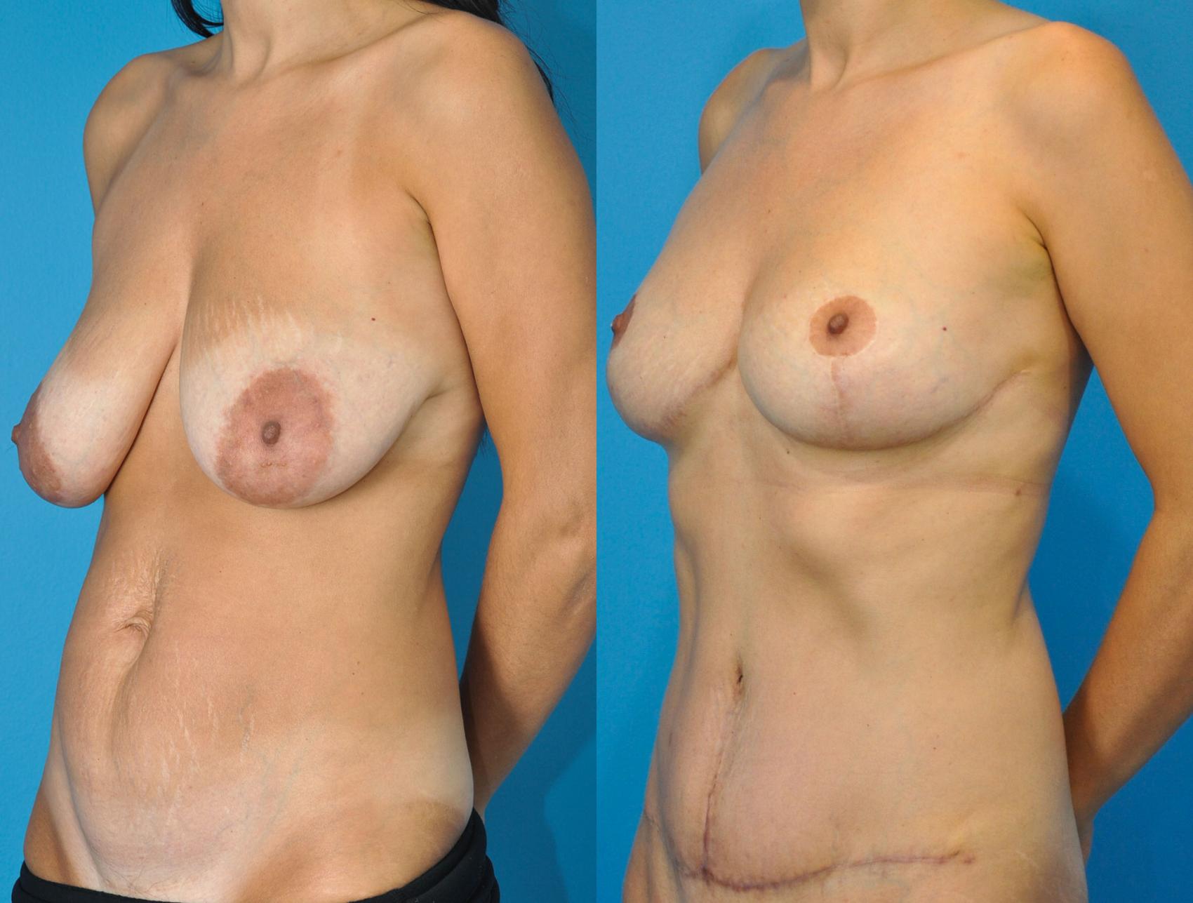 Before & After Abdominoplasty/Tummy Tuck Case 7 View #1 View in Northbrook, IL