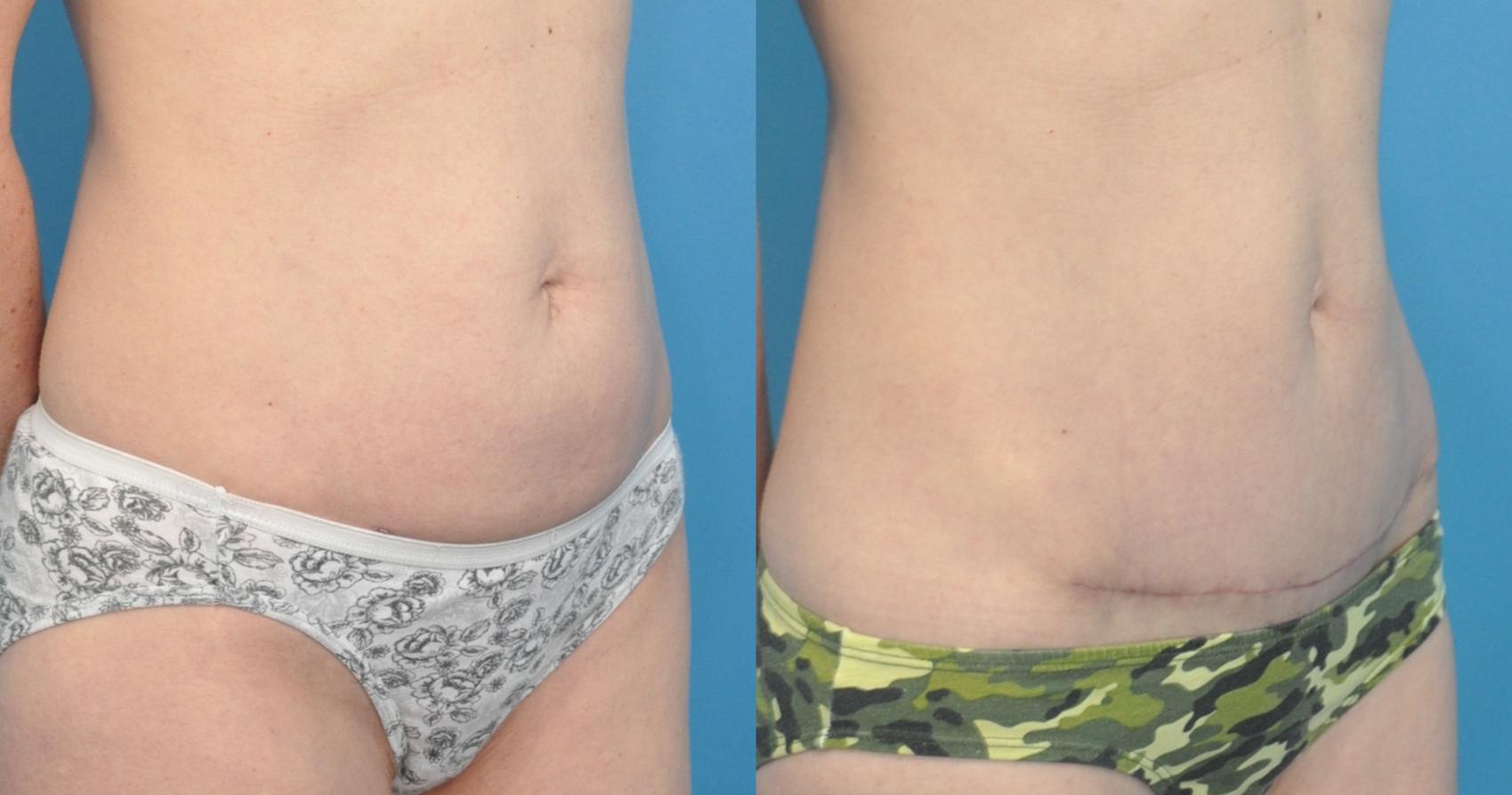 Before & After Abdominoplasty/Tummy Tuck Case 82 View #1 View in North Shore, IL