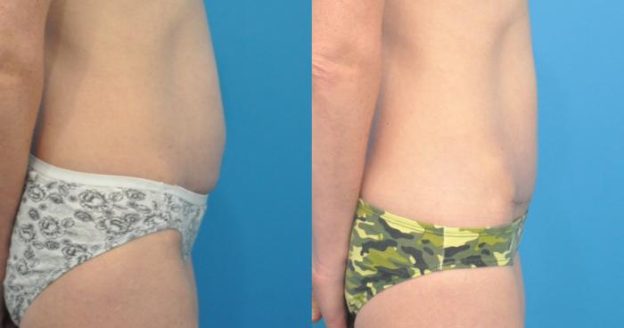 Before & After Abdominoplasty/Tummy Tuck Case 82 View #2 View in North Shore, IL