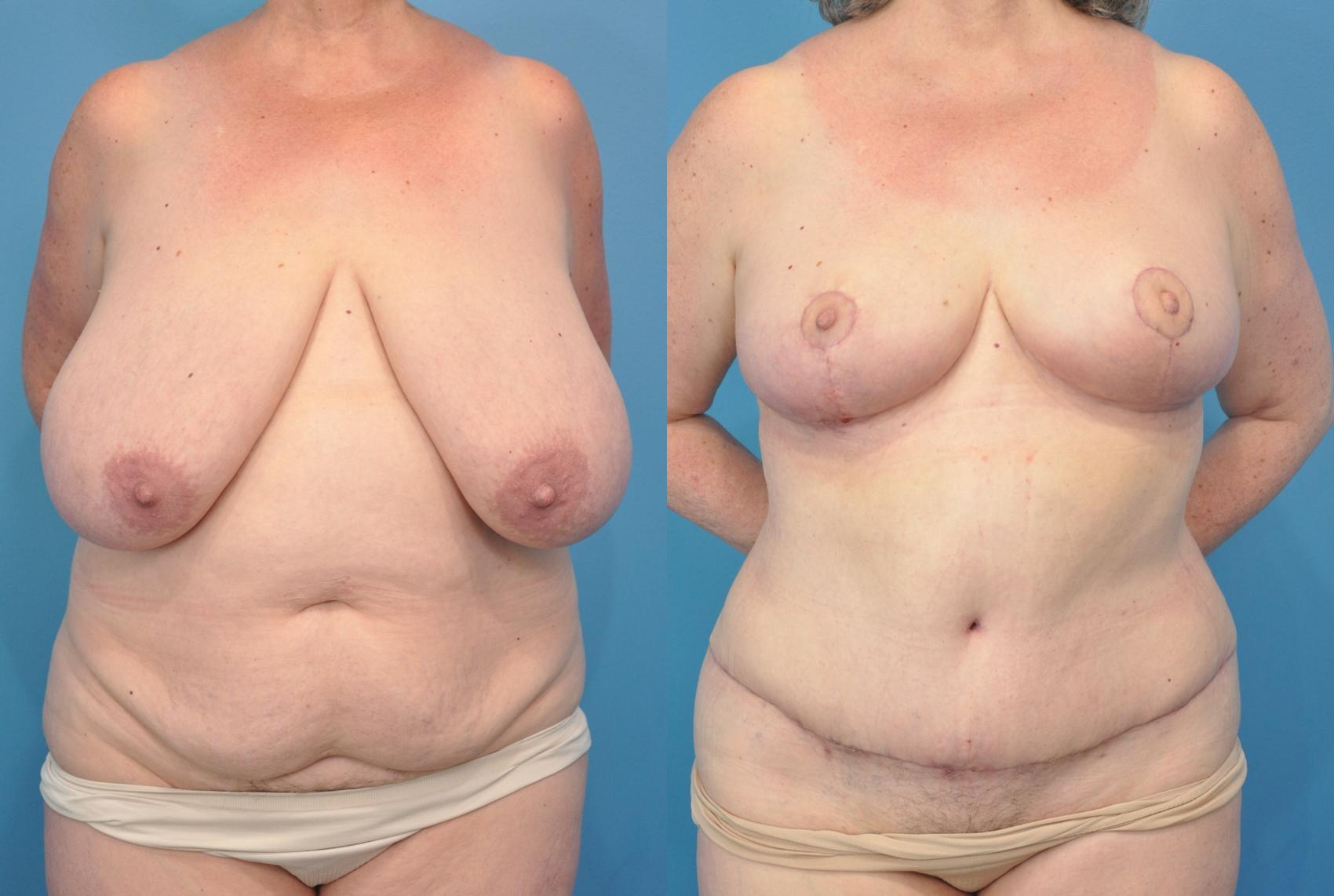 Before & After Abdominoplasty/Tummy Tuck Case 92 View #1 View in Northbrook, IL