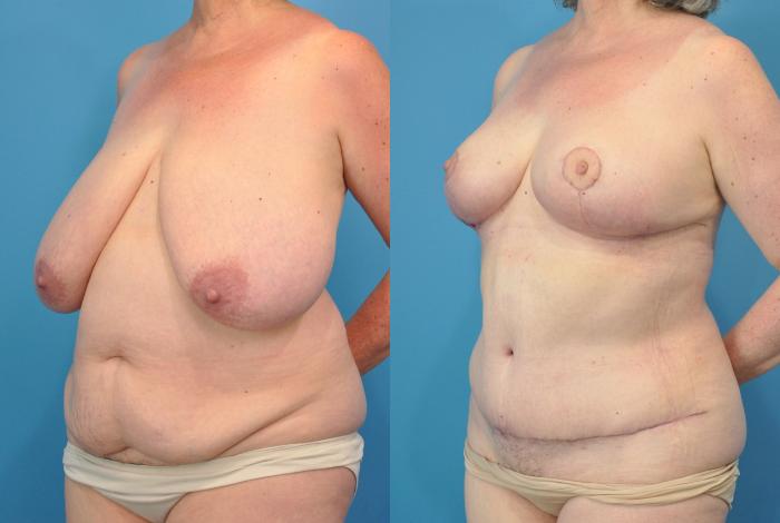Before & After Abdominoplasty/Tummy Tuck Case 92 View #2 View in North Shore, IL