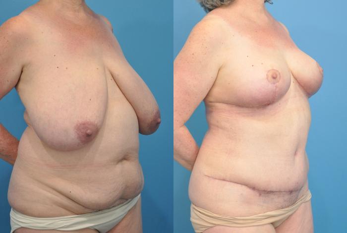 Before & After Abdominoplasty/Tummy Tuck Case 92 View #3 View in North Shore, IL